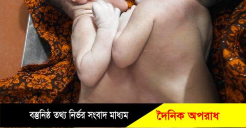 লালমোহনে পেট জোড়া লাগানো জমজ বাচ্চার জন্ম