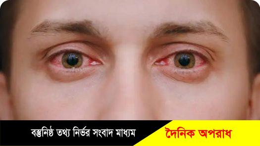 হবিগঞ্জে বাড়ছে চোখ ওঠা রোগী, আতঙ্কিত না হয়ে সতর্কতার পরামর্শ চিকিৎসকদের। 